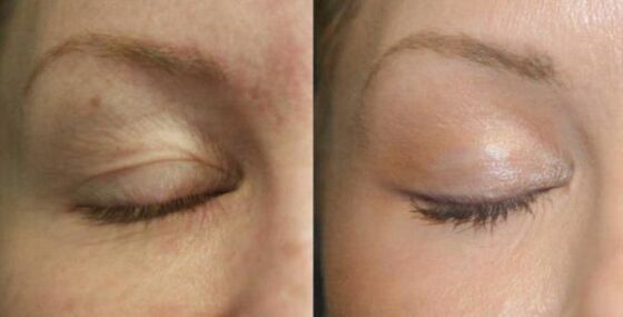 Caring for the area near the eyes