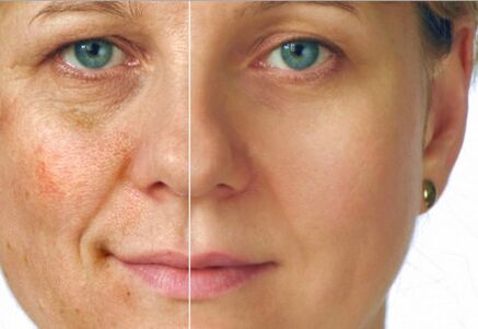 Rejuvenation results