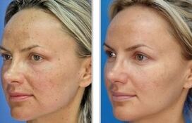 Laser peeling off