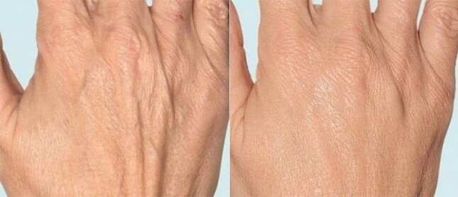Hand skin before and after fractional therapy