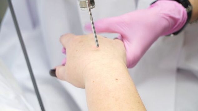 Hand skin rejuvenation with laser