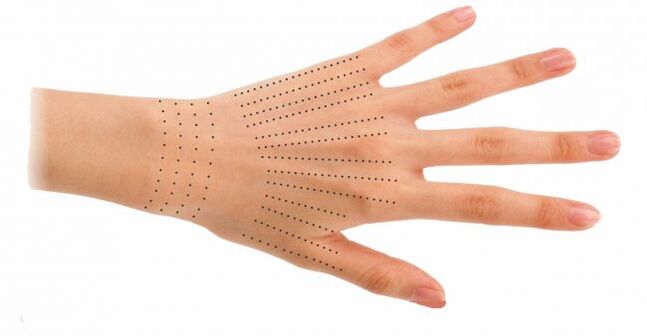 Injection site for hands during biorevitalization